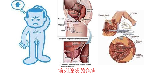 前列腺病的治療方法及其重要性，前列腺病的治療方法與重要性解析