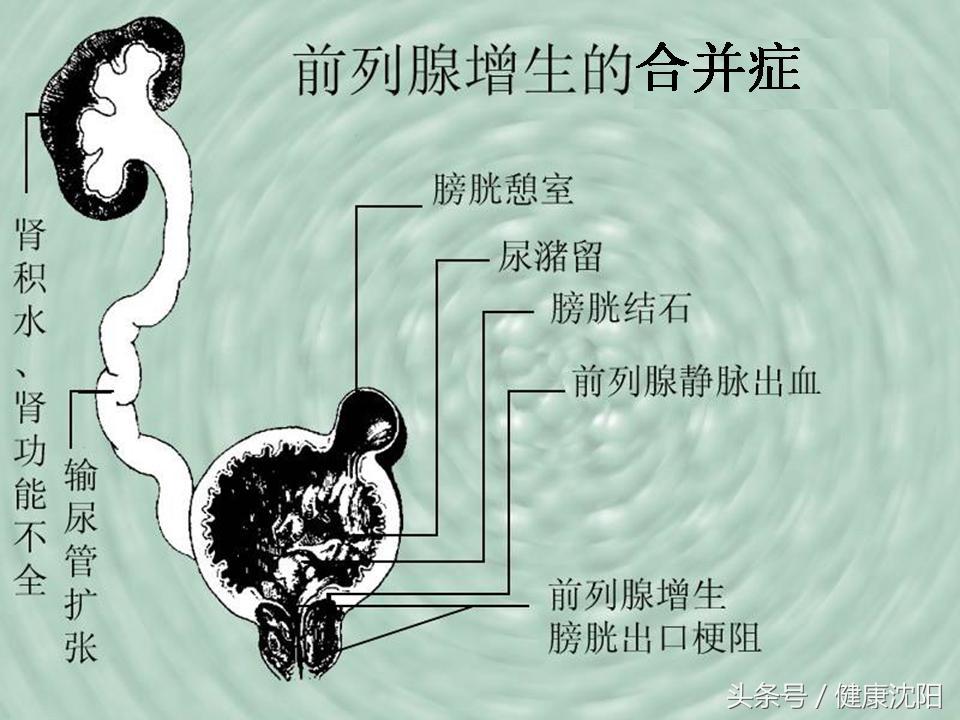 前列腺炎結(jié)石的癥狀表現(xiàn)，前列腺炎結(jié)石的癥狀表現(xiàn)及影響