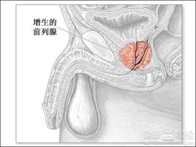 怎樣控制前列腺增生，如何控制前列腺增生
