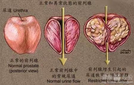 前列腺增生如何治療與控制，前列腺增生治療與控制的策略方法