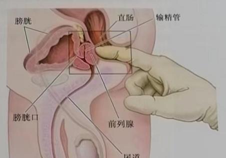 前列腺按摩方法及其重要性，前列腺按摩方法及其重要性解析