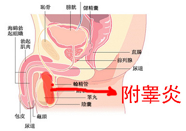 附睪炎的治療方法及用藥探討，附睪炎治療方法和藥物探討