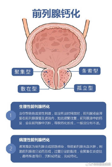 前列腺鈣化斑的藥物治療與康復(fù)路徑探索，前列腺鈣化斑的藥物治療與康復(fù)路徑探究