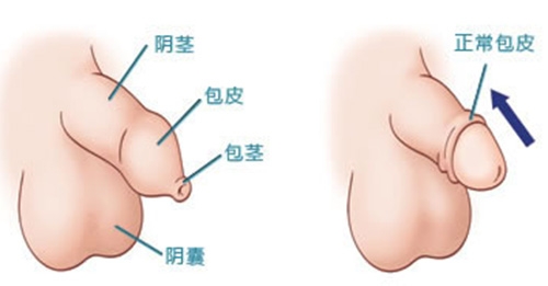 關(guān)于三十幾歲割包莖是否晚了的問題探討，三十幾歲割包莖是否晚了的探討與解析