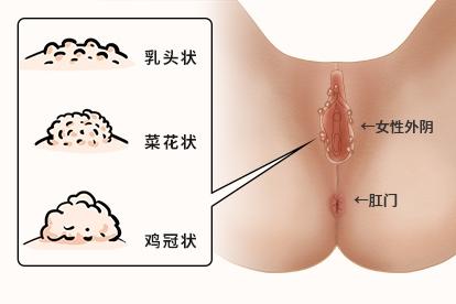 女性尖銳濕疣癥狀圖片，了解、預防與治療，女性尖銳濕疣，癥狀圖片解析、預防與治療方法